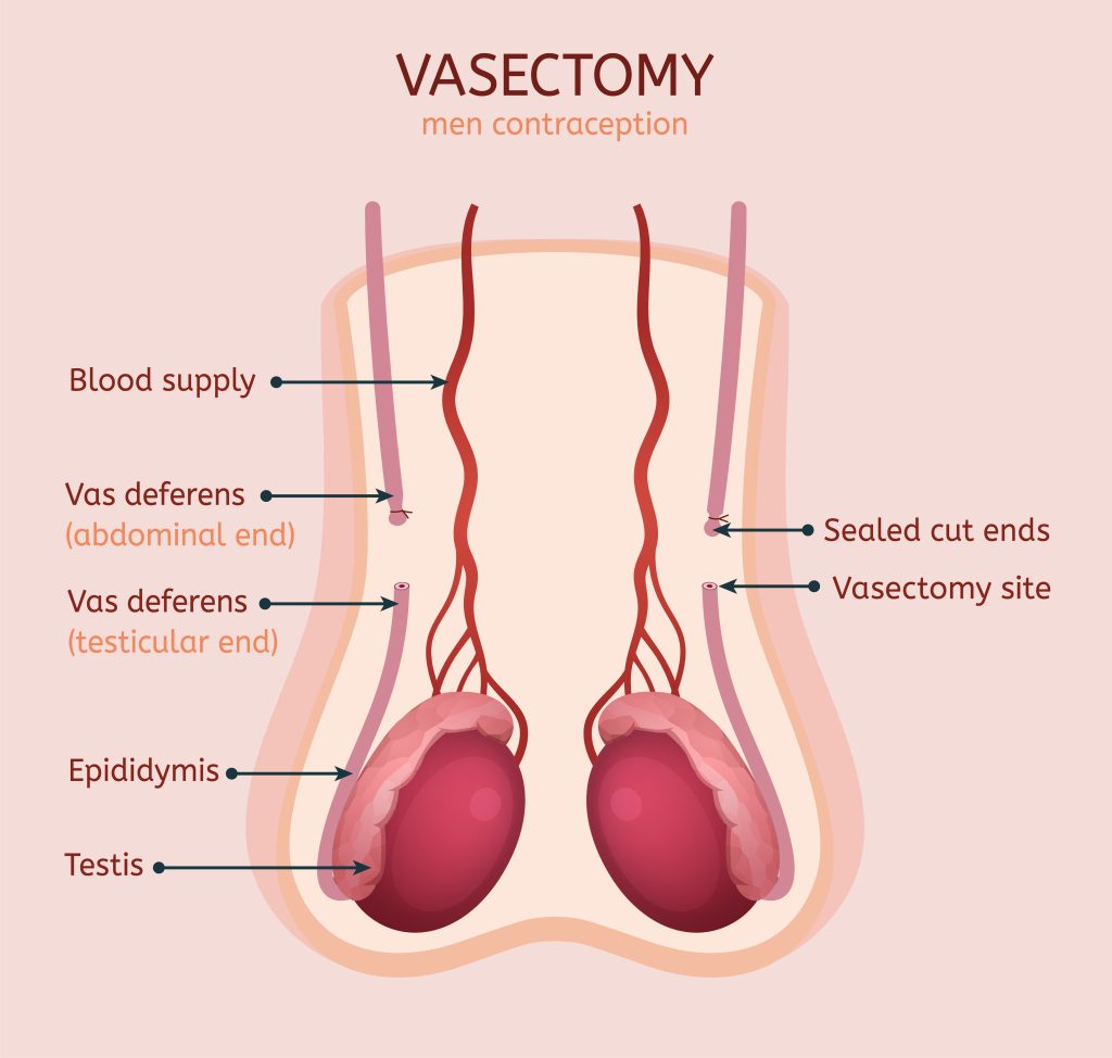 How is a vasectomy done